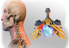 Thoát vị đĩa đệm cột sống cổ