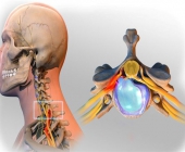 Thoát vị đĩa đệm cột sống cổ